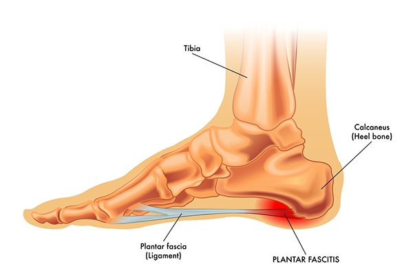 espolon y fascitis plantar