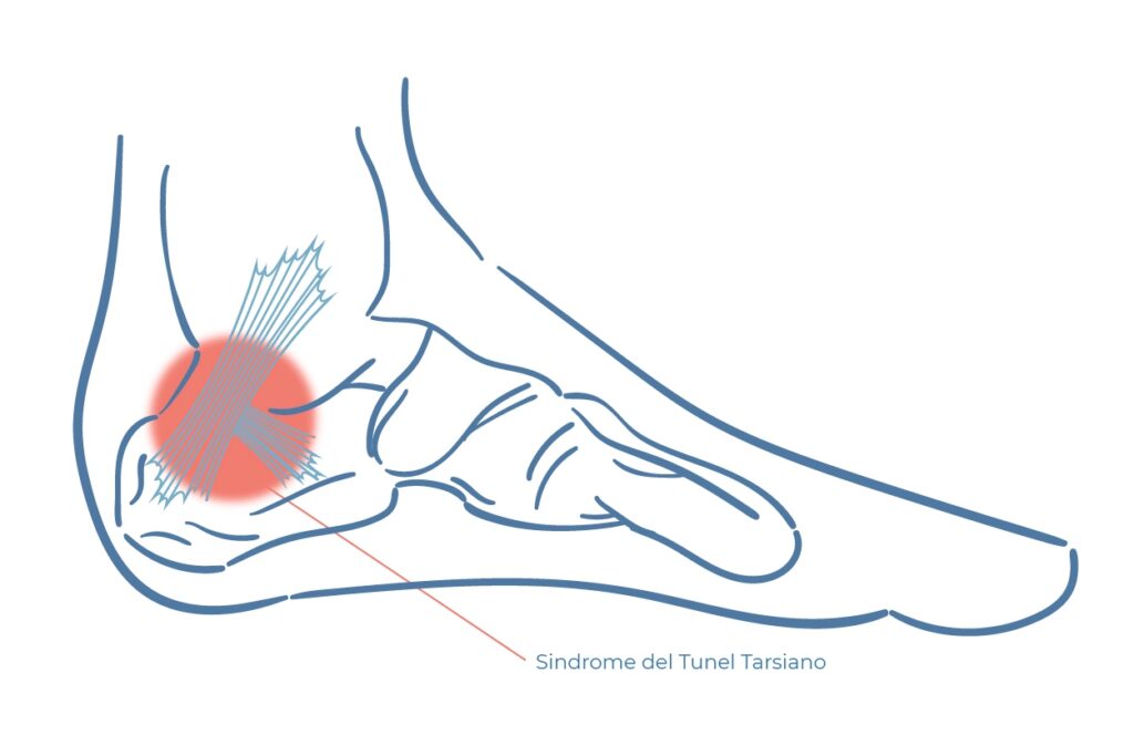 síndrome del túnel tarsiano