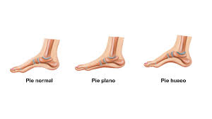 tipos de pie